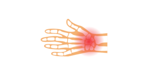 Fracture of the wrist joint